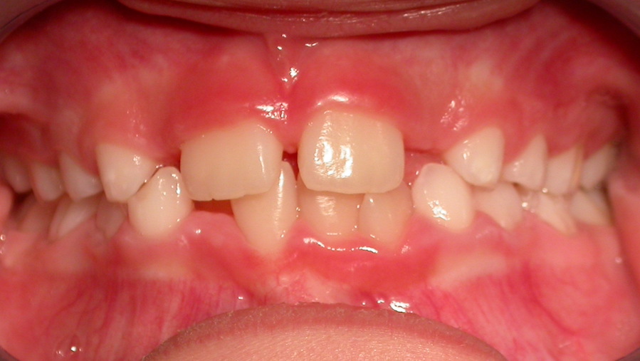 Schöne Zähne mit der Gratis Zahnspange - vorher