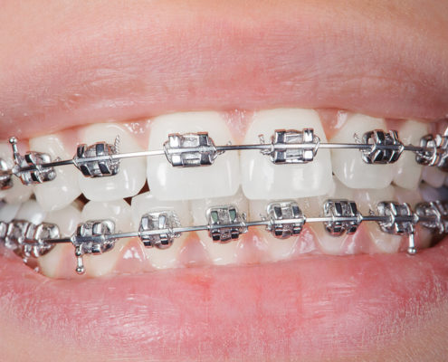 Metallbrackets für die feste Zahnspange
